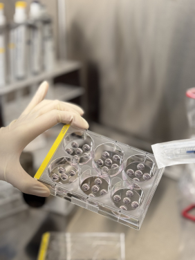 港大醫學院研究團隊從瑪麗醫院胃癌患者的組織培養出70個腸化生類器官，能真實模擬腸化生轉變為胃癌的過程。
 